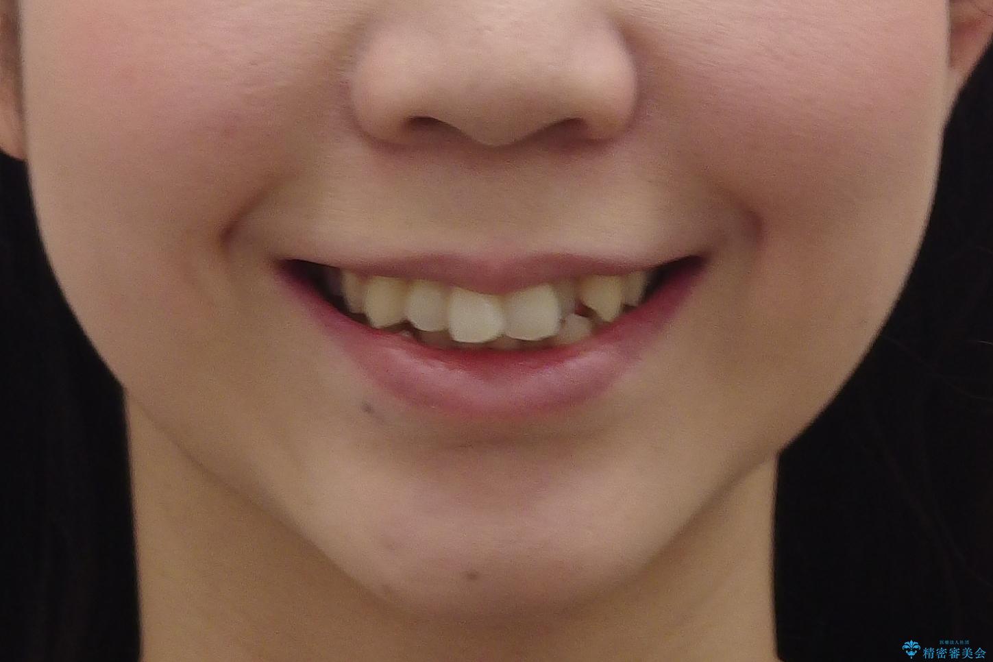 20代女性　口元を下げたい　前歯のがたつきの治療前（顔貌）