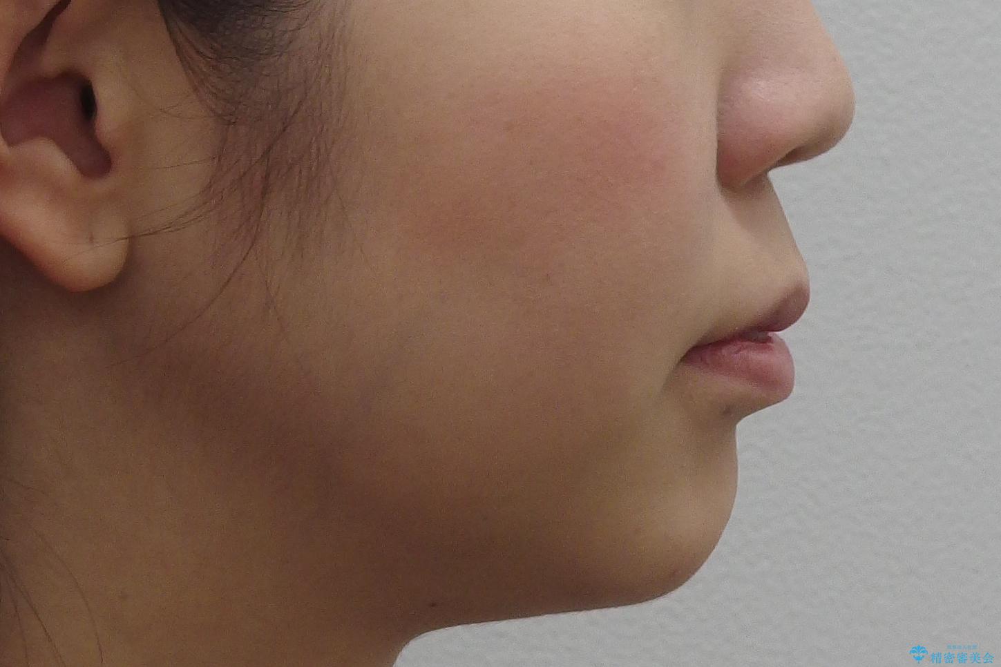 20代女性 口元を下げたい 前歯のがたつきの治療前(顔貌)