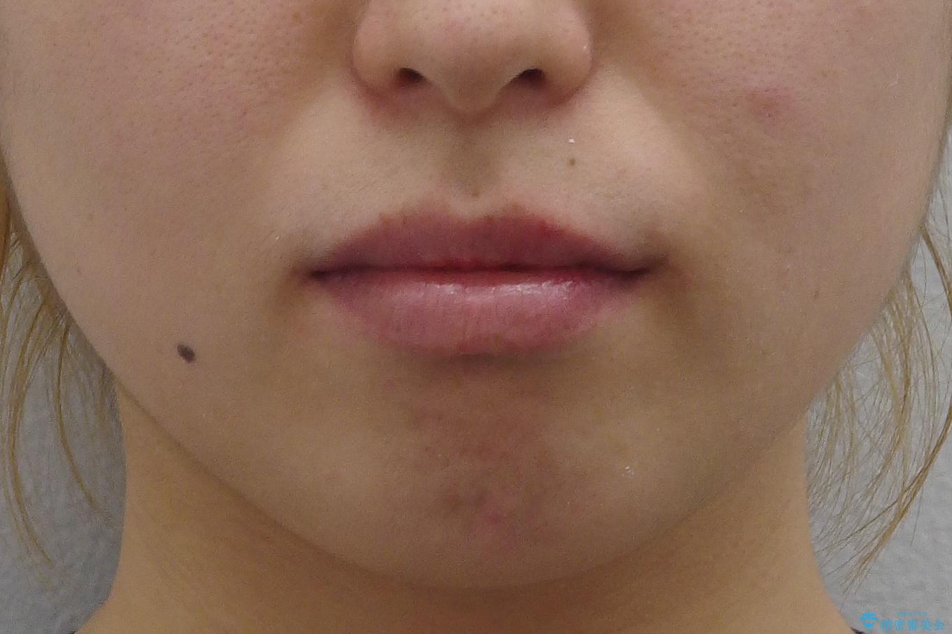 八重歯の治療 仕上がり重視での治療前(顔貌)