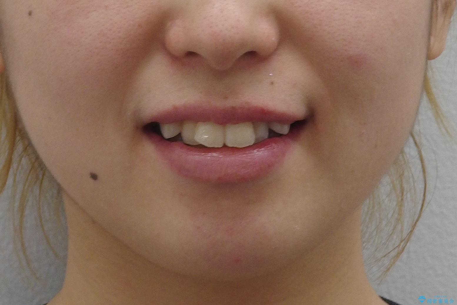 八重歯の治療 仕上がり重視での治療前(顔貌)