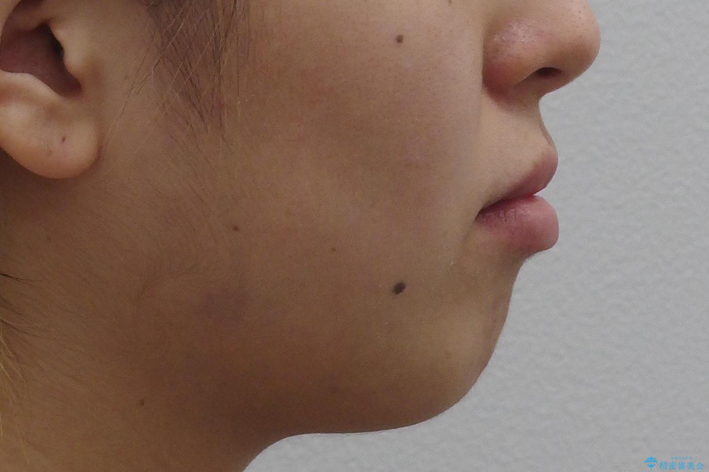 八重歯の治療 仕上がり重視での治療前(顔貌)