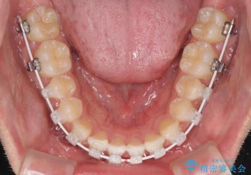 美容歯科でも断られた　著しい前歯のクロスバイトをワイヤー矯正で改善の治療中