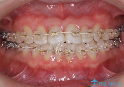受け口の改善 歯を抜かずに矯正の治療中
