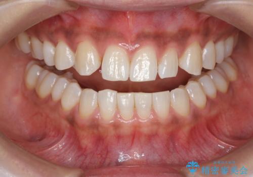 ホワイトニングで白い歯に 1日でできますの治療後