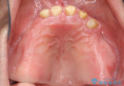 [インプラントオーバーデンチャー] インプラントで奥歯を支える部分床義歯の治療前