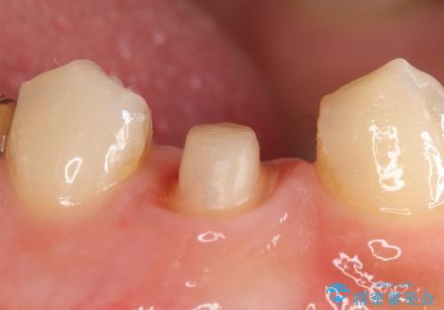 オールセラミッククラウン 咬むと痛む歯の根管治療~補綴の治療中