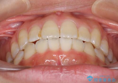 上下の前歯のがたつき 歯を抜かずに矯正の治療後