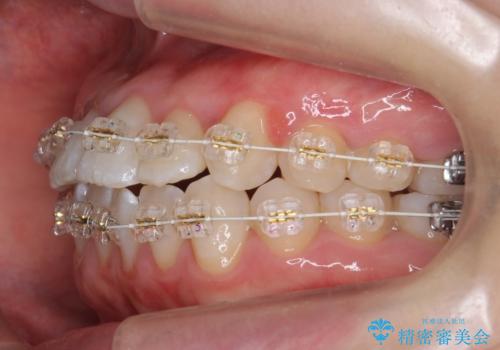 受け口の改善 歯を抜かずに矯正の治療中