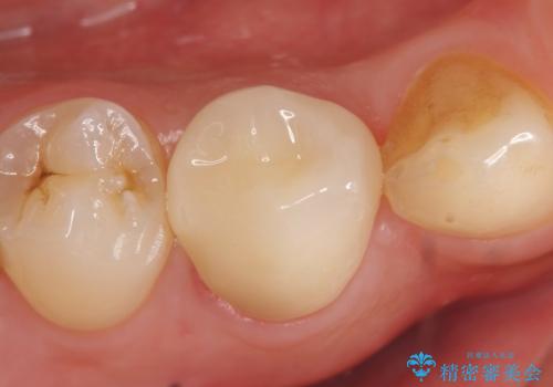 オールセラミッククラウン　咬むと痛む歯の根管治療～補綴の治療後