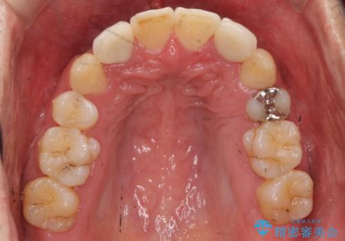 八重歯の矯正+歯のないところにインプラントの治療後