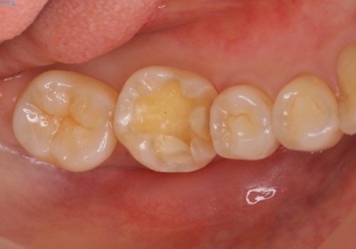 銀歯を白く セラミックインレーにの治療中