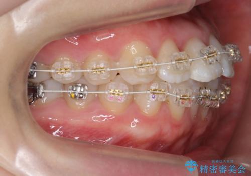 受け口の改善 歯を抜かずに矯正の治療中