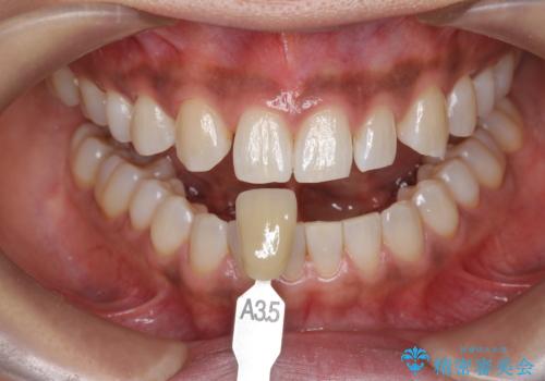 ホワイトニングで白い歯に 1日でできますの治療後