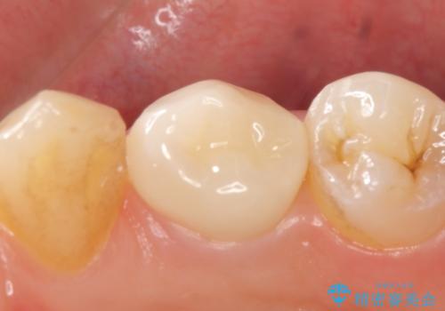 オールセラミッククラウン 咬むと痛む歯の根管治療~補綴の治療後