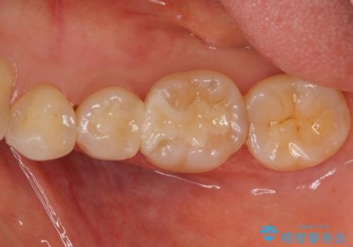 目立つ銀歯を全て白く　セラミックで虫歯治療の治療後