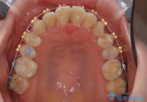 受け口の改善 歯を抜かずに矯正の治療中