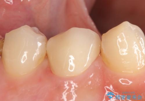 オールセラミッククラウン　咬むと痛む歯の根管治療～補綴の治療後