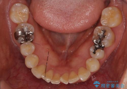 目立つ銀歯を全て白く　セラミックで虫歯治療の症例 治療前