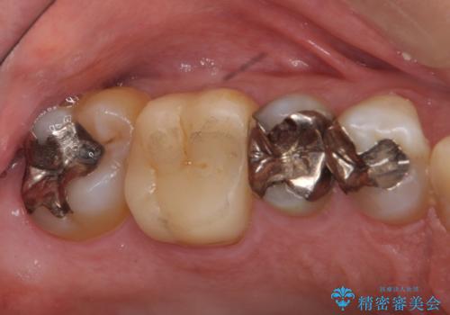 銀歯の下が虫歯　セラミックインレーにの症例 治療前