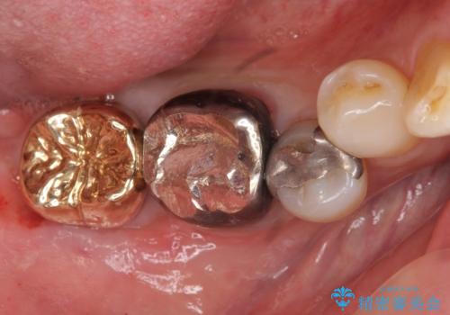 下の奥歯の虫歯　歯周外科手術を含めた治療の治療後
