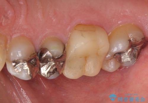 銀歯の下が虫歯 セラミックインレーにの治療前