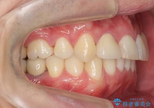 八重歯の矯正+歯のないところにインプラントの治療後
