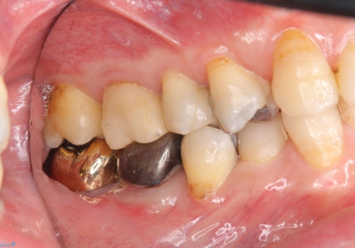 下の奥歯の虫歯　歯周外科手術を含めた治療の治療後