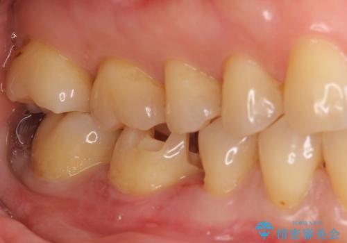 銀歯を白く セラミックインレーにの治療中