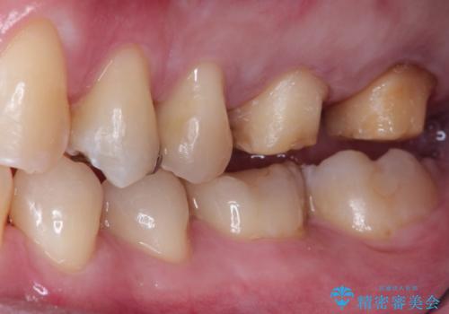 目立つ金歯を自然な色のオールセラミックへの治療中