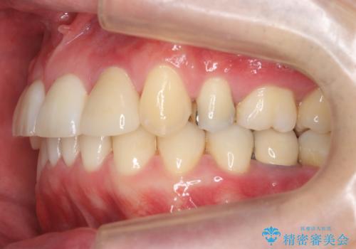 八重歯の矯正+歯のないところにインプラントの治療後