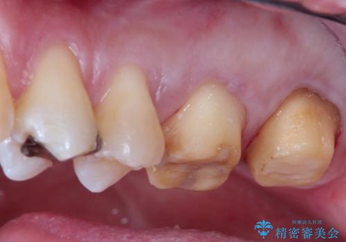 目立つ金歯を自然な色のオールセラミックへの治療中