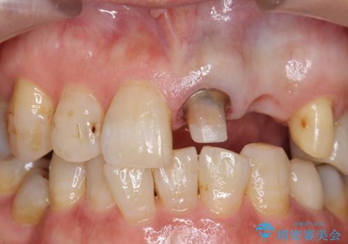オールセラミッククラウン 前歯のブリッジ 気になる見た目の改善の治療中