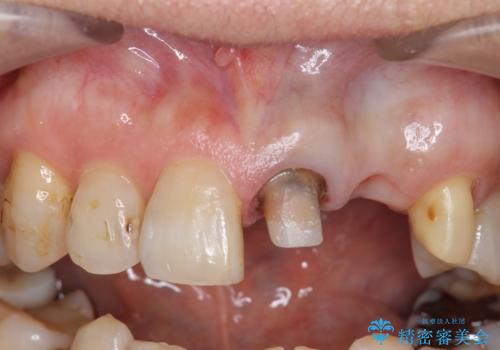 オールセラミッククラウン 前歯のブリッジ 気になる見た目の改善の治療中