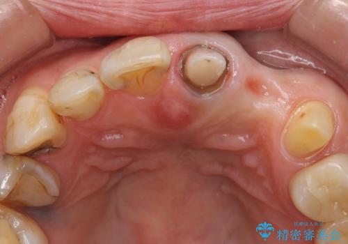オールセラミッククラウン 前歯のブリッジ 気になる見た目の改善の治療中