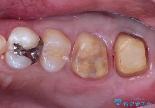 目立つ金歯を自然な色のオールセラミックへの治療中