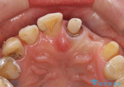 オールセラミッククラウン 前歯のブリッジ 気になる見た目の改善の治療中