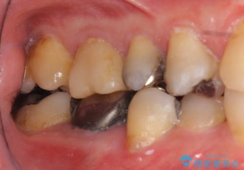下の奥歯の虫歯　歯周外科手術を含めた治療の治療前