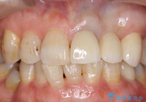 オールセラミッククラウン 前歯のブリッジ 気になる見た目の改善の治療後