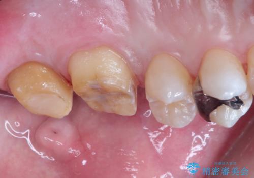 目立つ金歯を自然な色のオールセラミックへの治療中