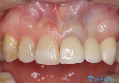 オールセラミッククラウン 前歯のブリッジ 気になる見た目の改善の症例 治療後
