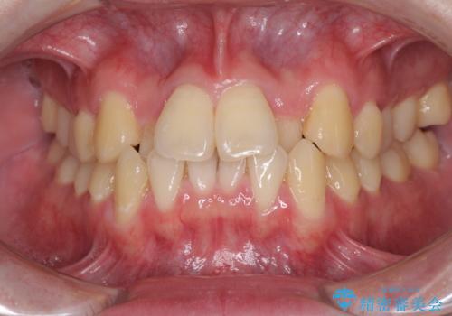 前歯のクロスバイト　インビザラインによる矯正治療の症例 治療前