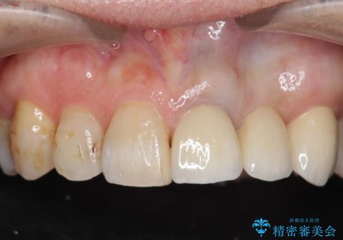 オールセラミッククラウン 前歯のブリッジ 気になる見た目の改善