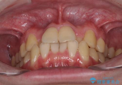 前歯のクロスバイト インビザラインによる矯正治療の治療前