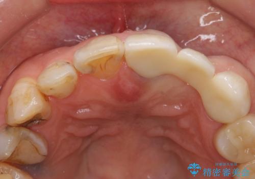 オールセラミッククラウン 前歯のブリッジ 気になる見た目の改善の治療後