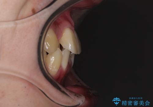 前歯のクロスバイト インビザラインによる矯正治療の治療前