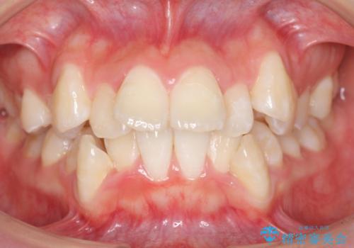 八重歯の治療　仕上がり重視での症例 治療前