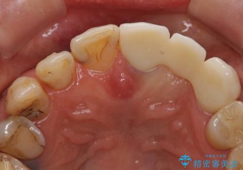 オールセラミッククラウン 前歯のブリッジ 気になる見た目の改善の治療後