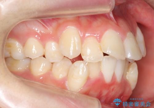 八重歯の治療　仕上がり重視での治療前