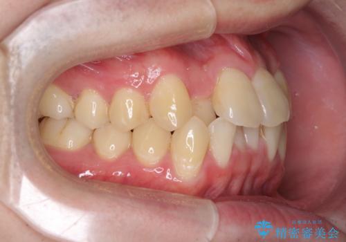 前歯のクロスバイト インビザラインによる矯正治療の治療前