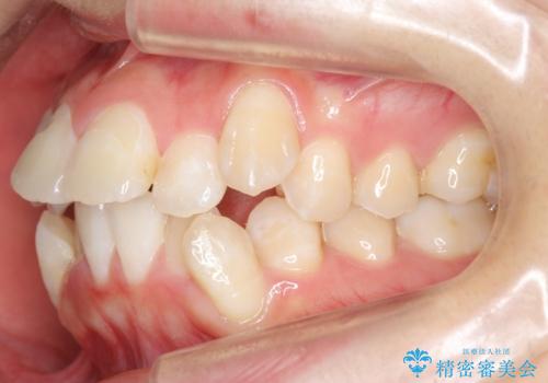 八重歯の治療 仕上がり重視での治療前